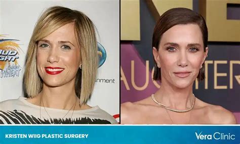 Did Kristen Wiig Have Plastic Surgery? Exploring the Rumors and Realities