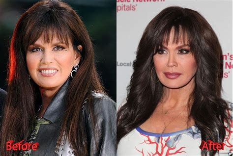 How Many Plastic Surgeries Has Marie Osmond Had: A Deep Dive into Celebrity Transformations and Public Perception